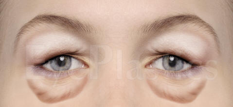 Cosmetic eyelid surgery, Blepharoplasty, Eyelift